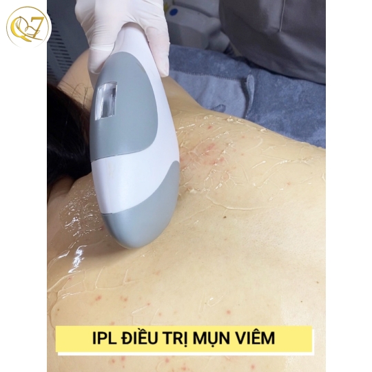 IPL điều trị mụn & kiểm soát nhờn