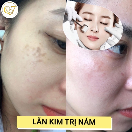 Lăn kim trị nám