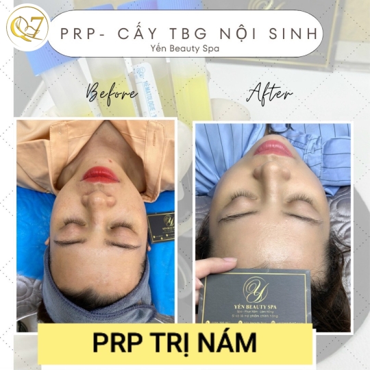 PRP phục hồi da điều trị nám