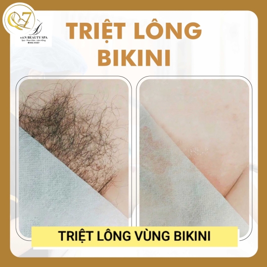 Triệt lông vùng Bikini
